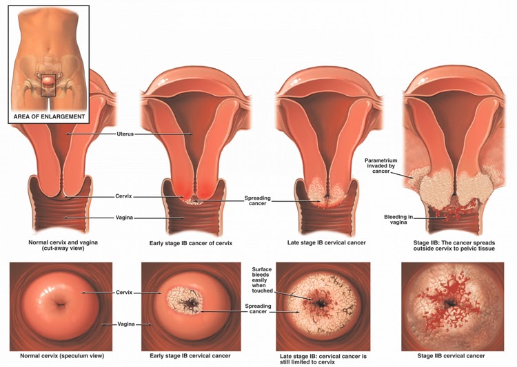 external vaginal cancer External vaginal cancer